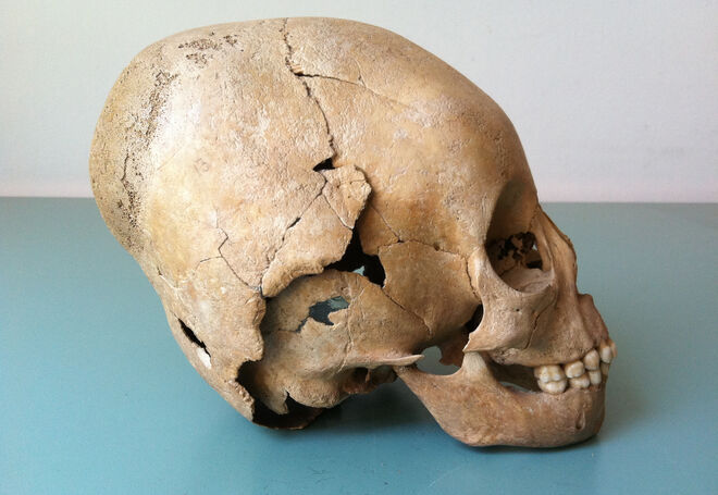 Cráneo modificado, una práctica atribuida a los hunos que podría haber sido adoptada por los agricultores locales dentro de los límites del Imperio Romano de Occidente.