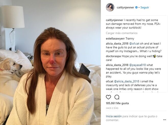 Caitlyn Jenner tiene un carcinoma basocelular canceroso.