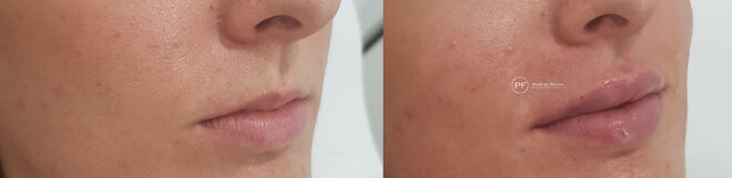 Antes y después del tratamiento con ácido hialurónico en los labios