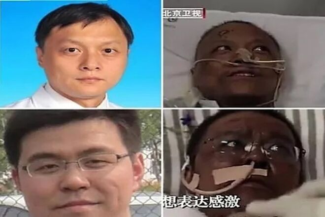 Dos médicos chinos se volvieron negros tras estar en coma por el coronavirus.