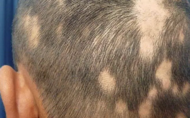 Calvas en alopecia areata
