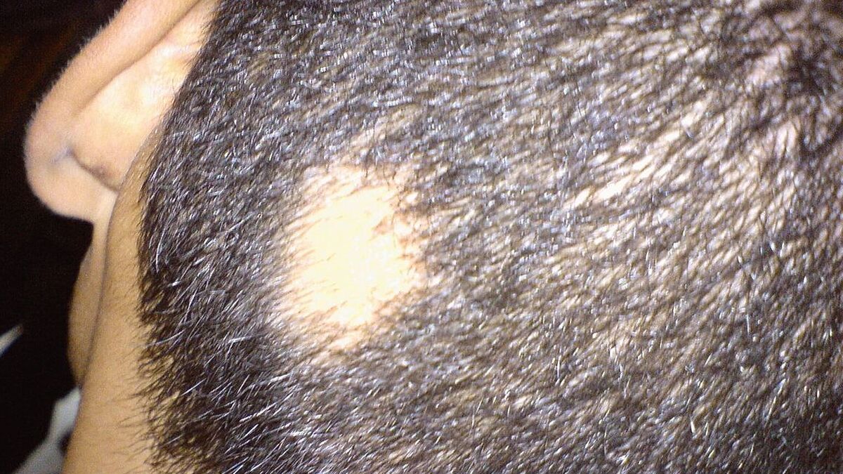 El tipo raro de alopecia que algunos hombres (y que causa