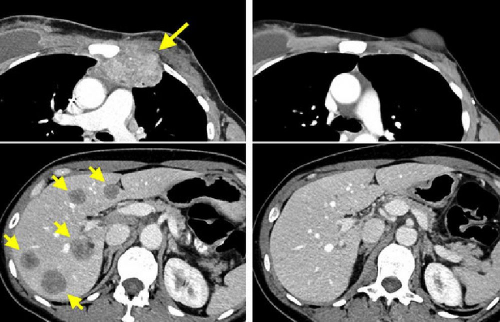 Eliminan un cáncer de mama metastásico mediante inmunoterapia - Vozpópuli