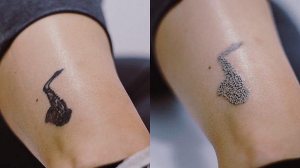 Despídete de ese tatuaje que tanto odias: ya es posible borrarlo sin dejar huella