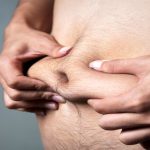 La tecnología para eliminar la grasa localizada como alternativa a la liposucción