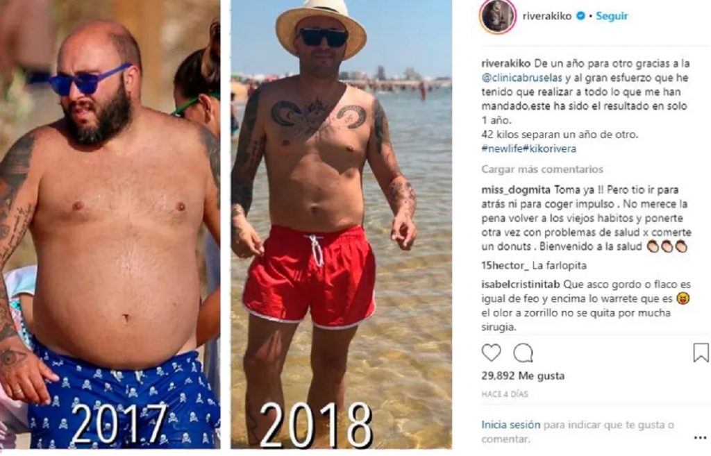 El antes y el después de Kiko Rivera tras implantarse un balón gástrico
