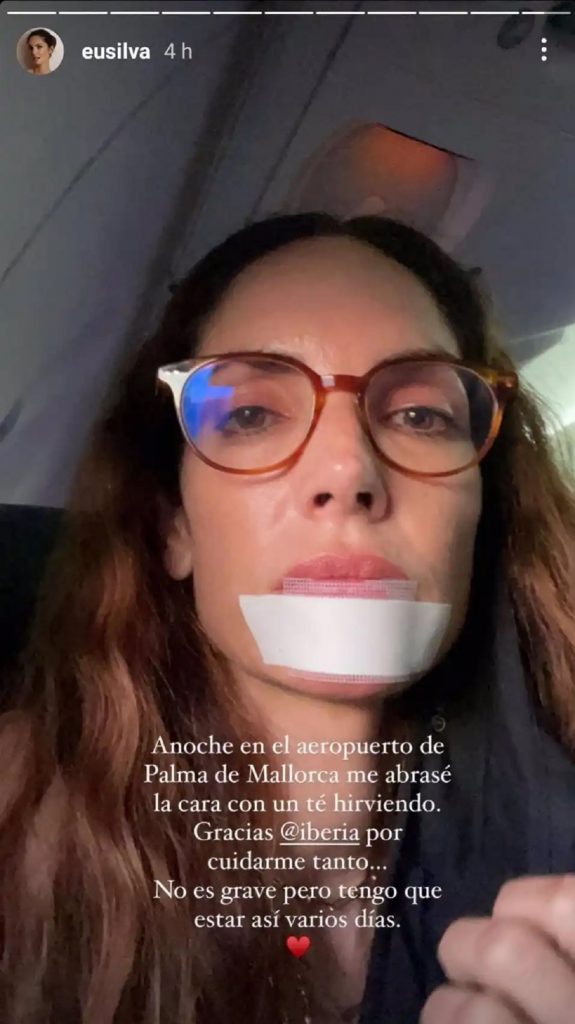 Eugenia Silva se abrasa la cara durante las vacaciones