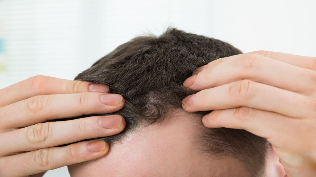 caida pelo alopecia calvicie cabello enfermedades señales