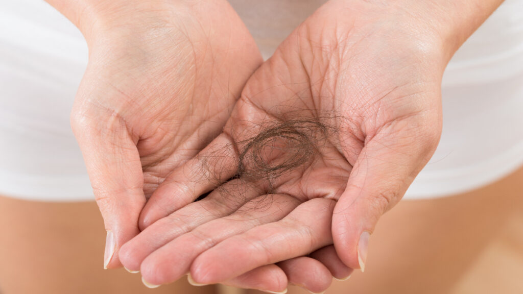 caida pelo alopecia calvicie cabello enfermedades señales
