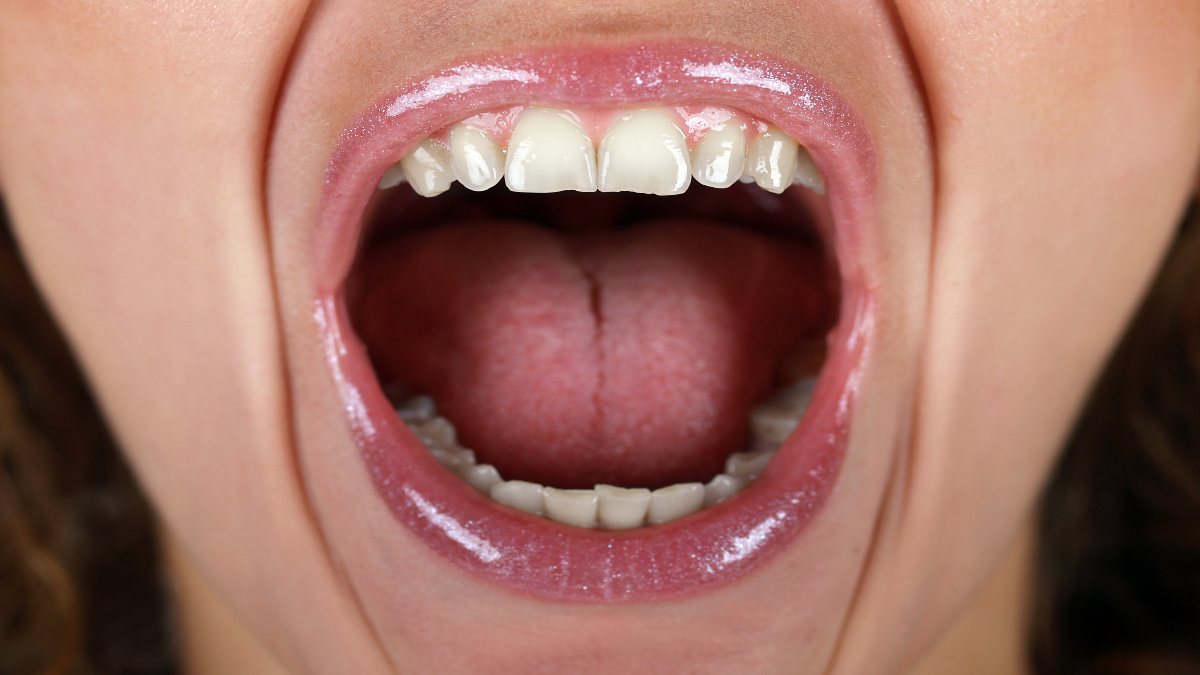 salud dental dientes reflujo gastrico daños acidez dentista