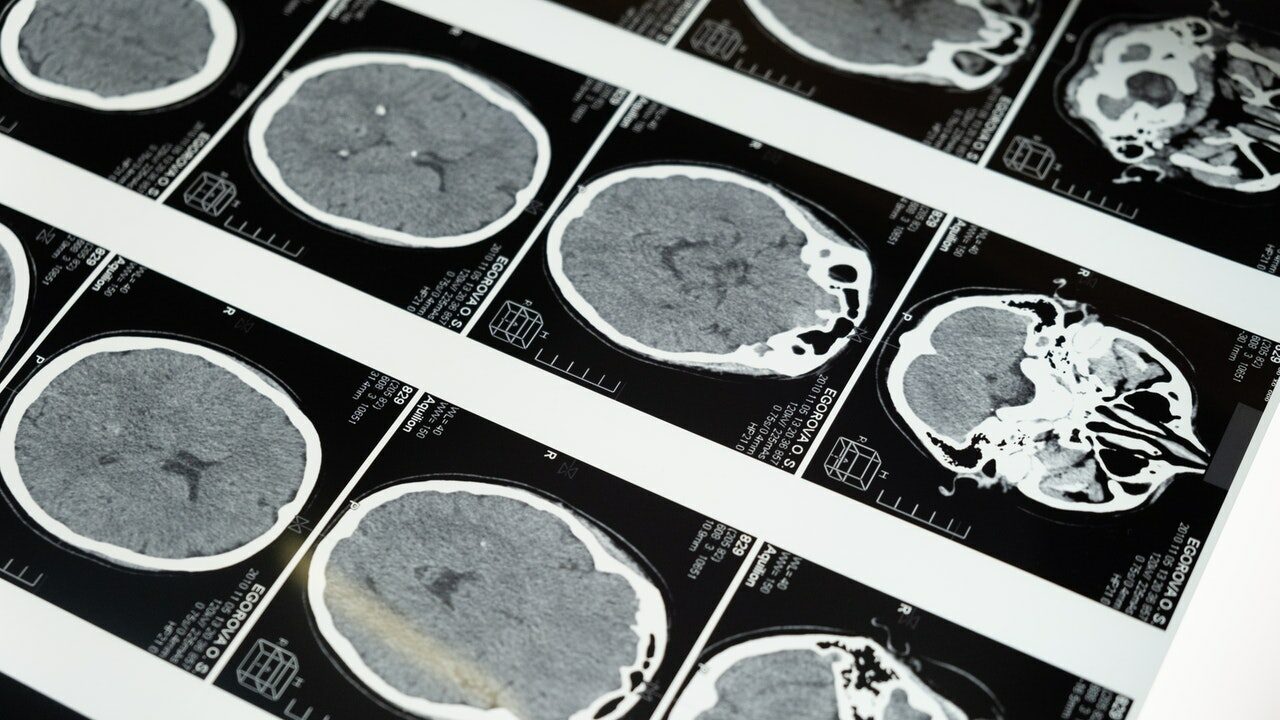 Un nuevo fármaco muestra eficacia preclínica para tratar la metástasis en el cerebro