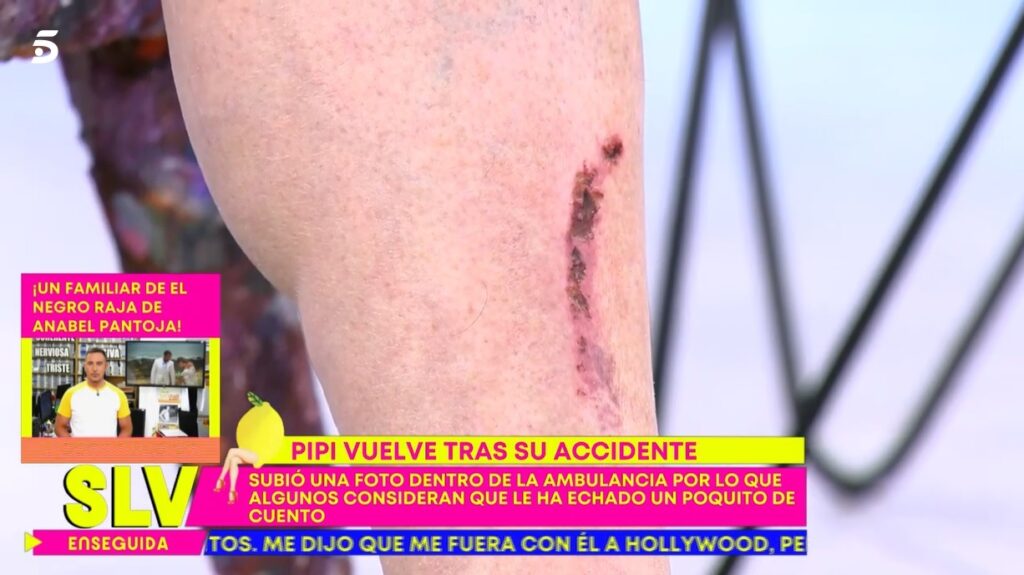 La herida de moto que se ha hecho Pipi Estrada