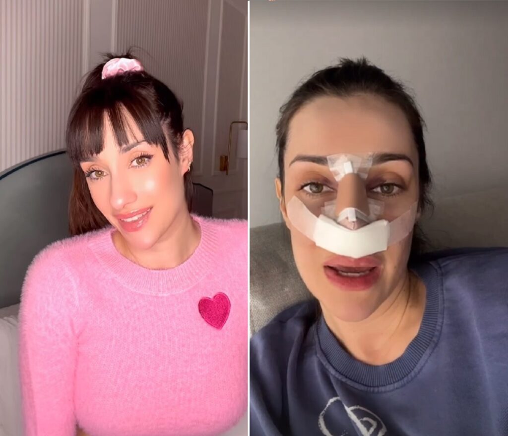 El antes y el después de Adara Molinero tras la operación de nariz