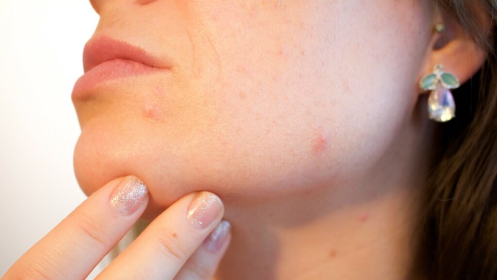 hipersensibilidad-acne-1