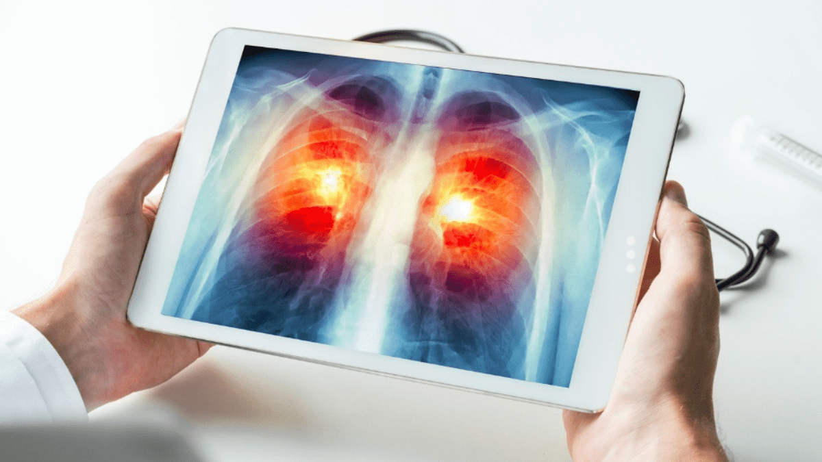 ¿Qué personas pueden participar en la criba para detectar el cáncer de pulmón?