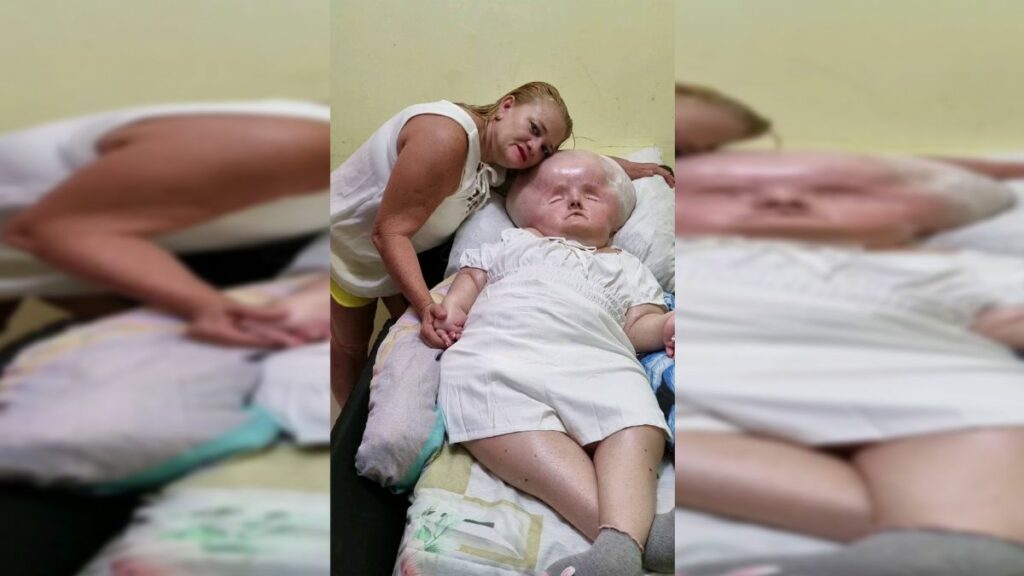 El extraño caso de un bebé que sufre hidrocefalia: 29 años y pesa 69 kilos