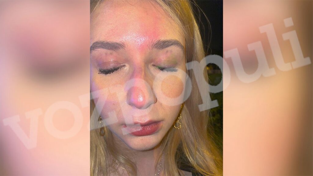 Una exconcursante de MasterChef es agredida en una discoteca y acaba con la nariz rota