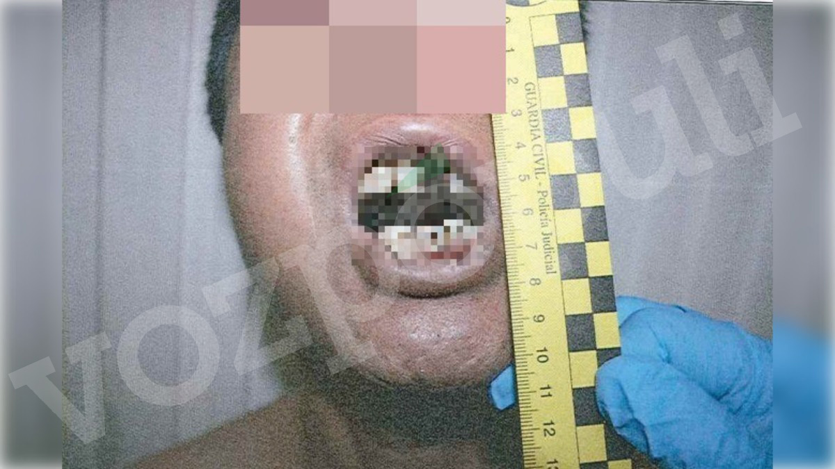 Las lesiones que presentaba en la cara el interno violado en la cárcel de Valdemoro