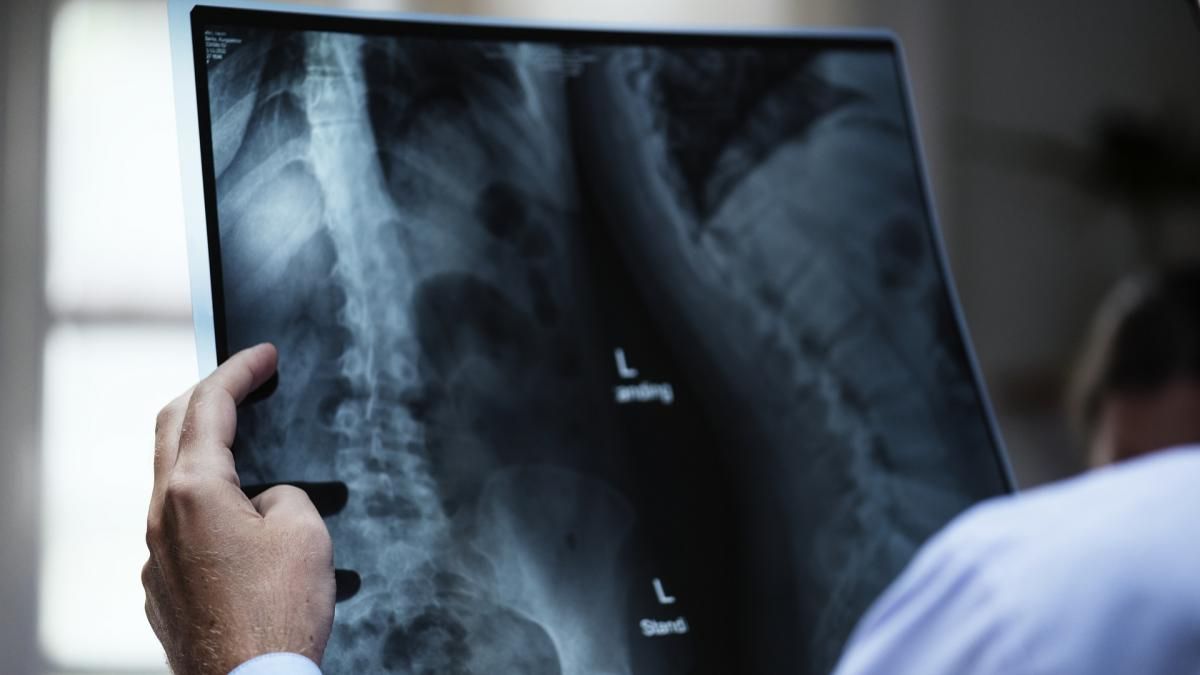 La Osteoporosis, todo lo que debes saber sobre la enfermedad silenciosa.