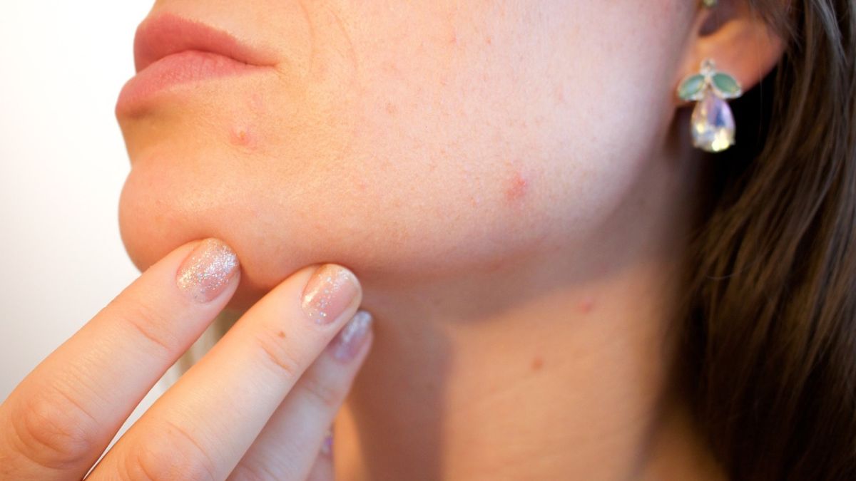 El tratamiento que aspira a terminar con el acné: una bacteria cutánea que produce moléculas terapéuticas