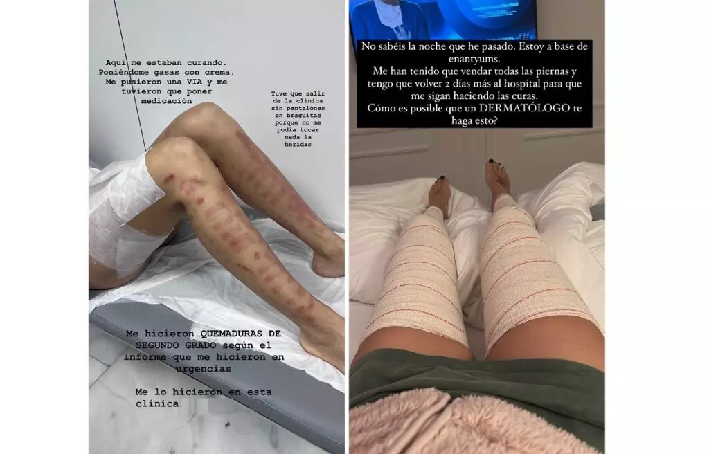 Adara Molinero publica las fotos de cómo le han quemado las piernas con el láser