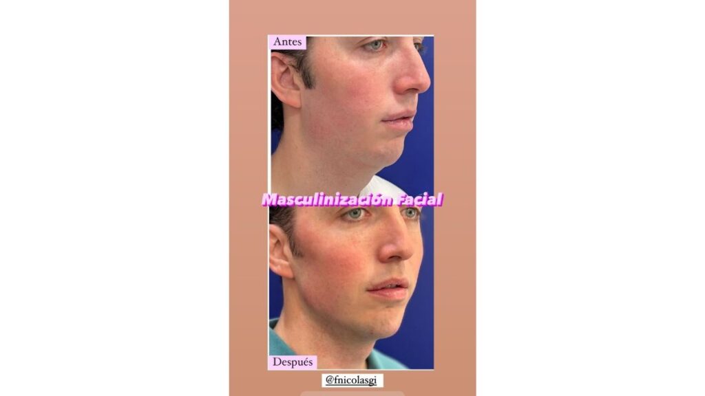 El antes y el después de la masculinización facial de El pequeño Nicolás
